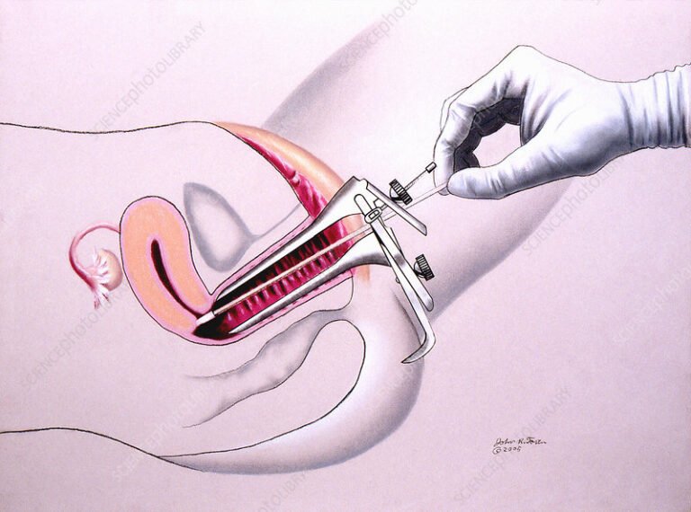 A Detailed Journey Through Laparoscopic Inguinal Hernia Surgery.