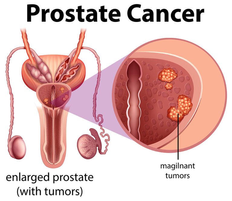 Navigating Prostate Cancer: A Comprehensive Guide to Detection and Treatment.