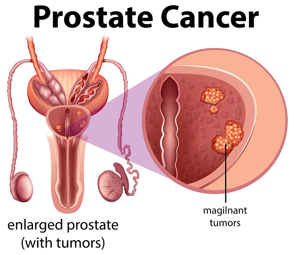 Navigating Prostate Cancer A Comprehensive Guide To Detection And Treatment Dr Saurabh 9119