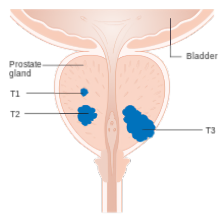 Prostate Cancer Demystified: A Comprehensive Roadmap for Understanding, Managing, and Thriving in Health.