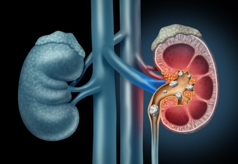 Laser Surgery for Kidney Stones: A Precision Approach to Stone Removal