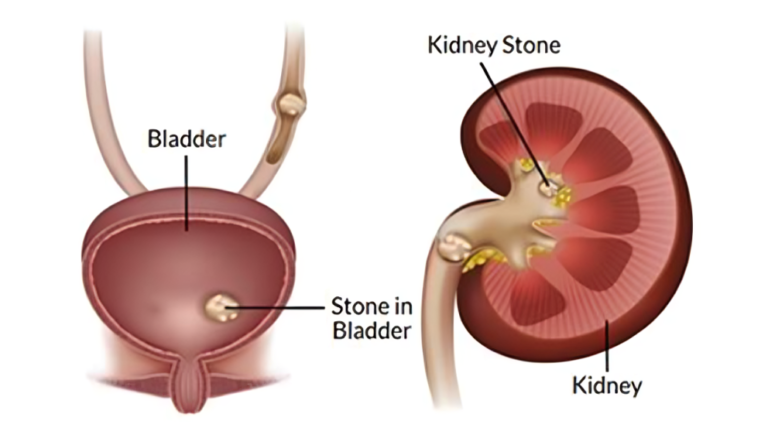 Breaking Down Bladder Stones: Causes, Symptoms, and Treatment Strategies