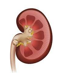 Navigating the Painful Path: Understanding and Managing Kidney Stones.