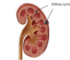 Unveiling Kidney Cancer: Understanding, Diagnosing, and Treating Renal Cell Carcinoma.