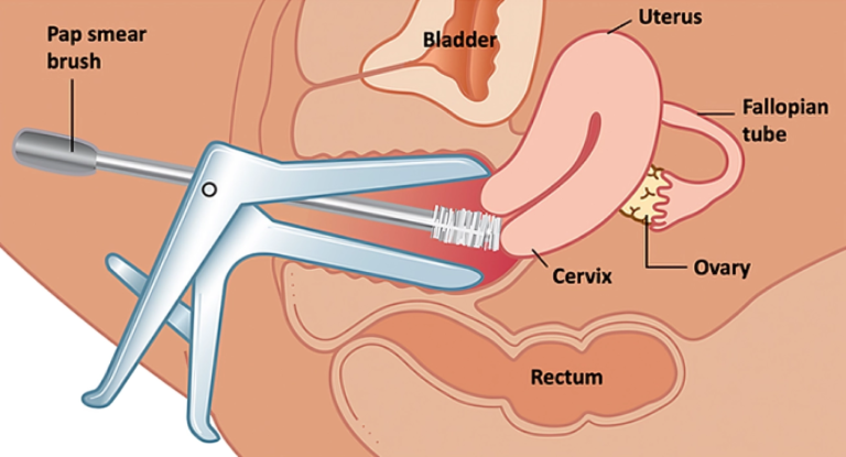 PAP Smear: A Crucial Screening Tool in Women’s Health.