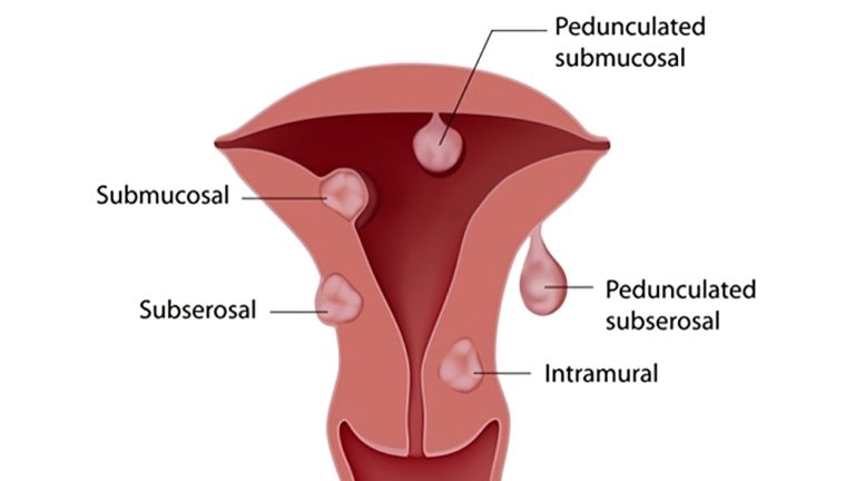 Unraveling Vaginal Infections: Causes, Symptoms, and Effective Treatments.