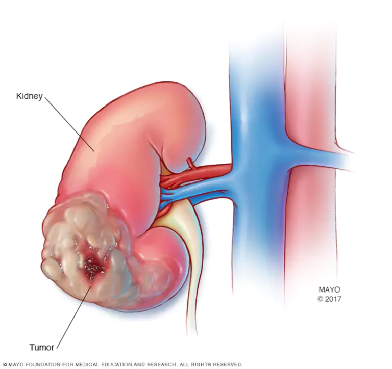 The Roots Signs and Approaches to Combat Kidney Cancer.