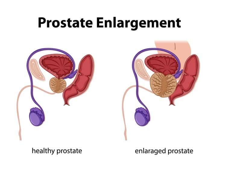 Prostate Enlargement And Aging: What Men Need To Know