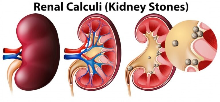 Best Kidney Stone Treatment in Tri Nagar.