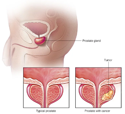 Medical illustration showing prostate gland anatomy and tumor comparison by the Best Prostate Cancer Surgeon in North Delhi