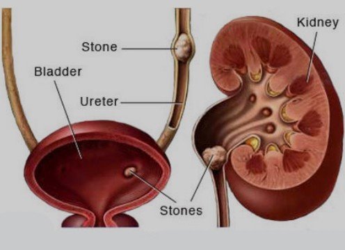 Best Bladder Stone Surgery in Rohini
