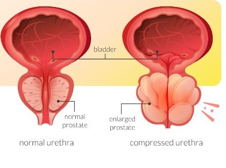 Best Treatment for Prostate Enlargement in North Delhi