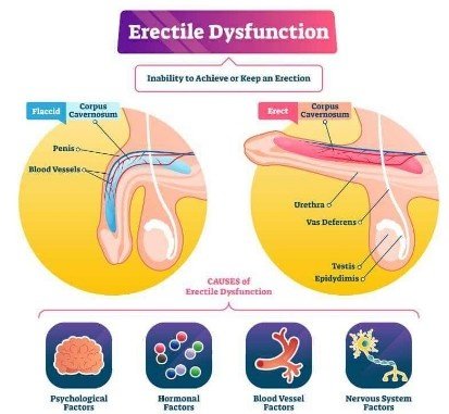 Best Erectile Dysfunction Surgeon in Rohini