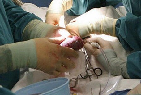 Best Kidney Transplant Treatment in North Delhi