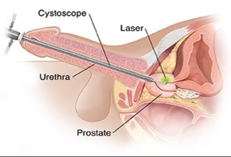 Best Prostate Laser Surgery in Delhi