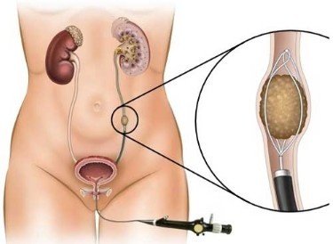 Best Laser Surgery for Bladder Stones in North Delhi