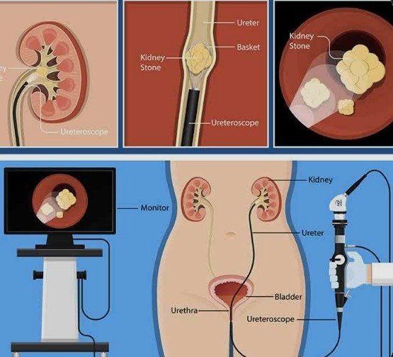 Ureteric Stone Treatment in Delhi