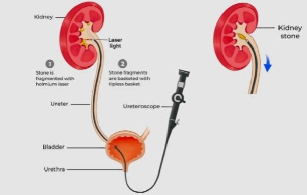 Affordable Ureteric Stone Treatment in Delhi