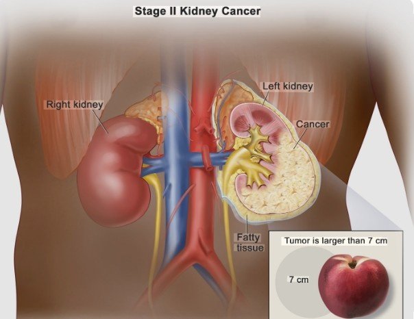 Kidney Cancer Treatment in East Delhi