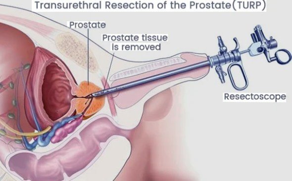 Prostate Cancer Surgery in Pitampura