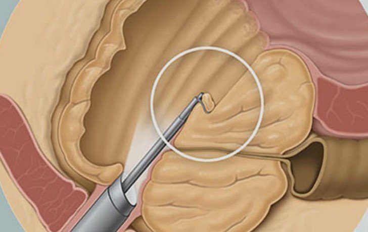 Best Laser Surgery for Prostate in Delhi