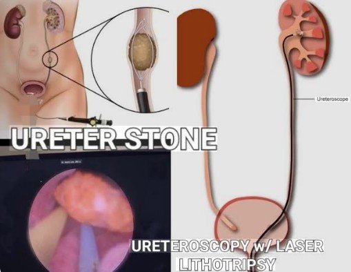 Kidney Stone Removal Laser Treatment Rohini