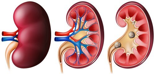 Kidney Stone formation shown in three stages, including the external view of a kidney, an internal cross-section, and kidney stones lodged inside the renal collecting system